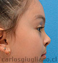 Rinoplastia Fisurados
