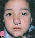 Hemangioma Nasal