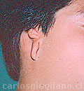 Microtia o Agenesia del Oído