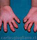 Sindactilia Compleja