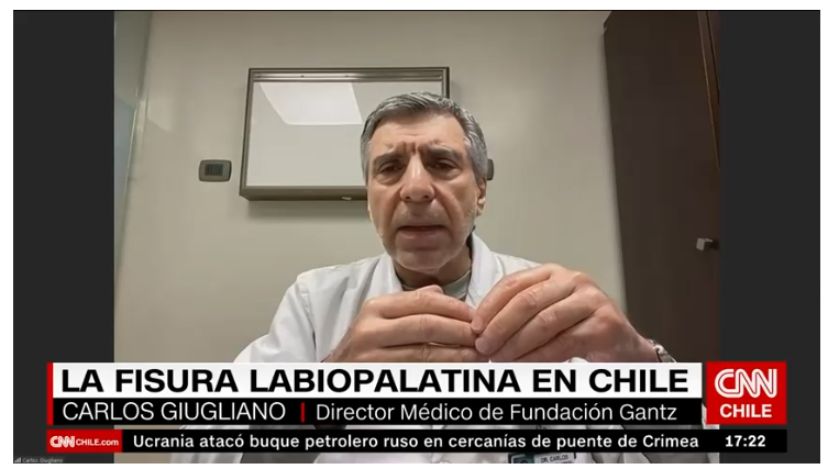 El Dr. Carlos Giugliano, director médico de la Fundación Gantz, conversó con CNN Chile sobre la fisura labiopalatina